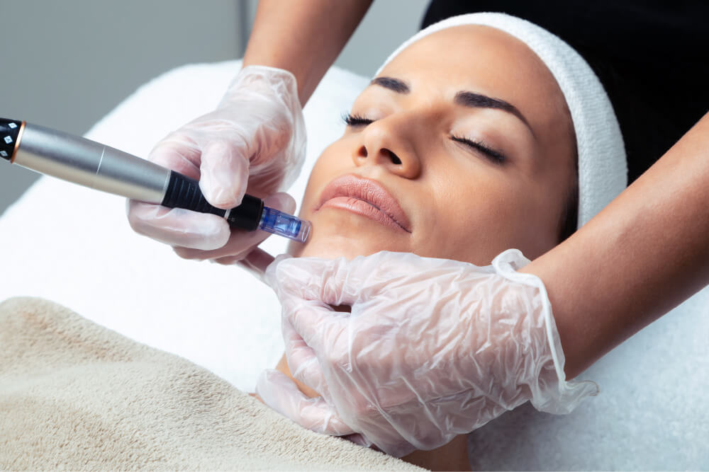 Microneedling: Unlocking The Power Of Collagen Renewal For Flawless Skin